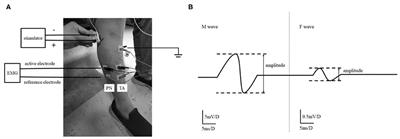 Differential Changed Excitability of Spinal Motor Neurons Innervating Tibialis Anterior and Peroneus Muscles Cause Foot Inversion After Stroke